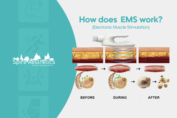 EMS treatment for post pregnancy weight loss treatment Wales