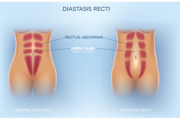 What Non-Surgical Options Are Available for Diastasis Recti Wales?
