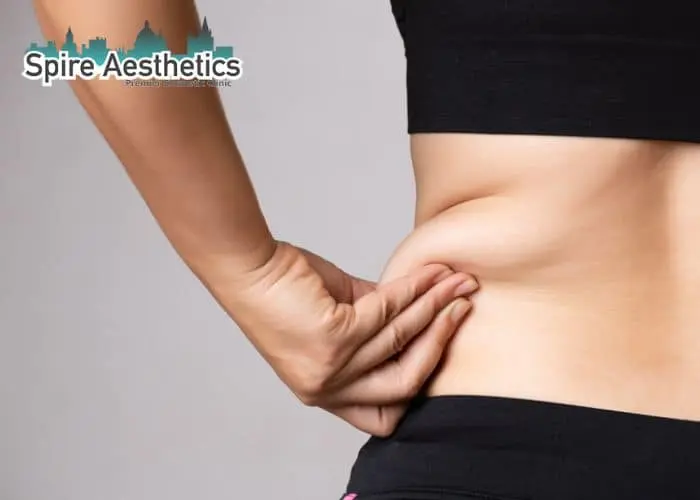 Image of woman pinching fat on their hips Wales. Fat Freezing treatment