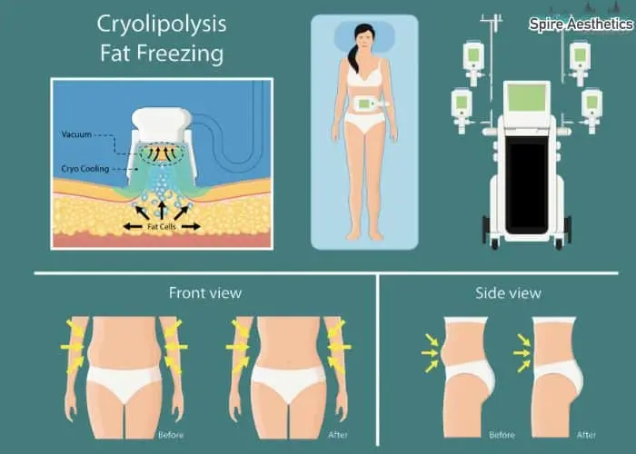 Fat freezing treatment Wales benefits for competitions to remove stubborn fat deposits.