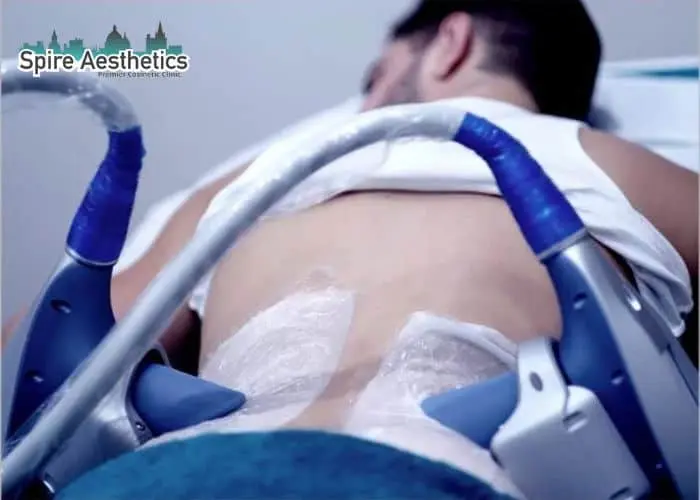 Man having fat freezing treatment done on love handles before a competitions Wales to create a sculpted look.