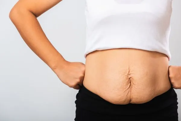Image of a woman's stomach after weight loss with sagging skin following a gastric band Wales