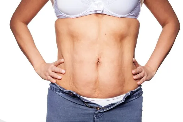 sagging skin on woman's stomach after weight loss injections Wales
