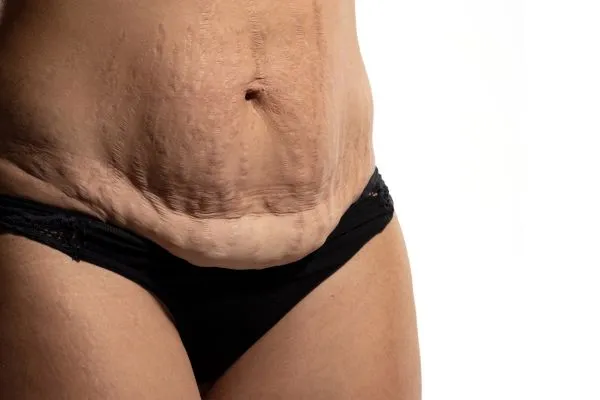 Image of womans stomach after weight loss injections Wales showing saggy skin