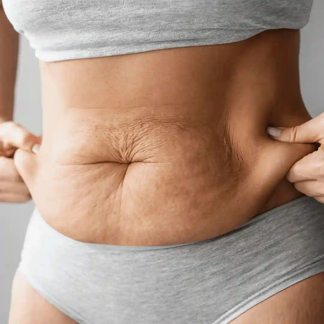 Is It Normal to Have Loose Skin After Pregnancy Wales?