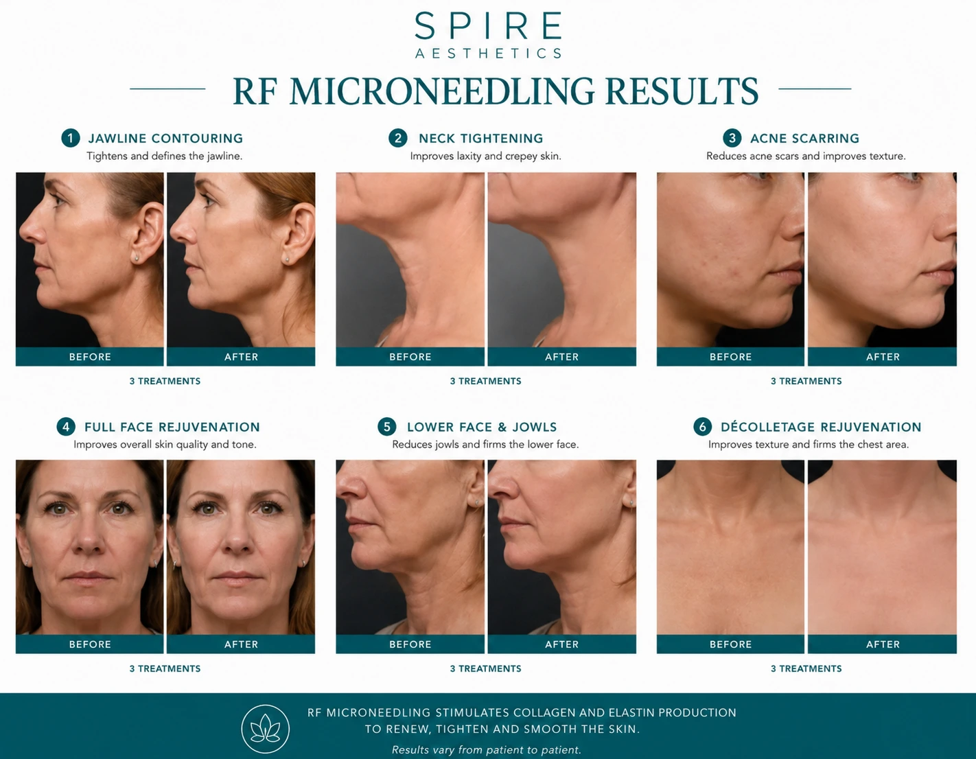 RF Microneedling Skin tightening Wales results