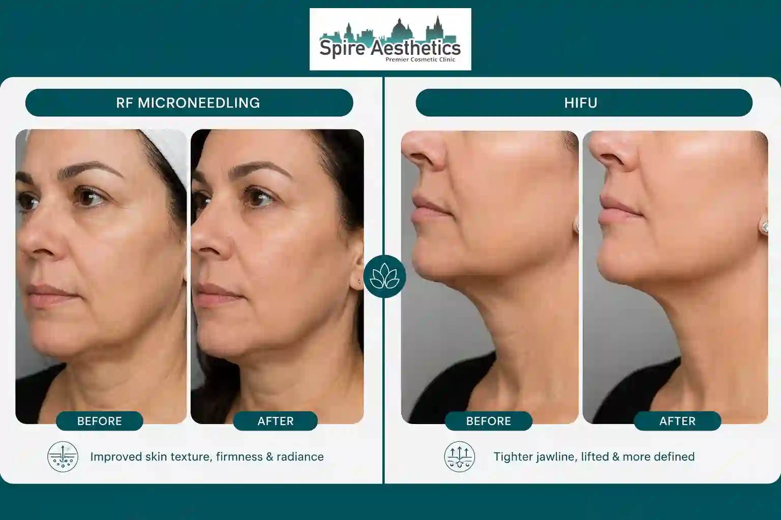 Can RF Microneedling and HIFU Be Combined Wales?