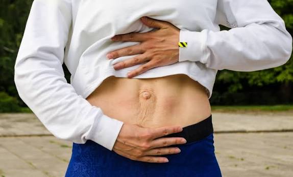 When Could Diastasis Recti Be the Missing Piece of the Puzzle Wales?