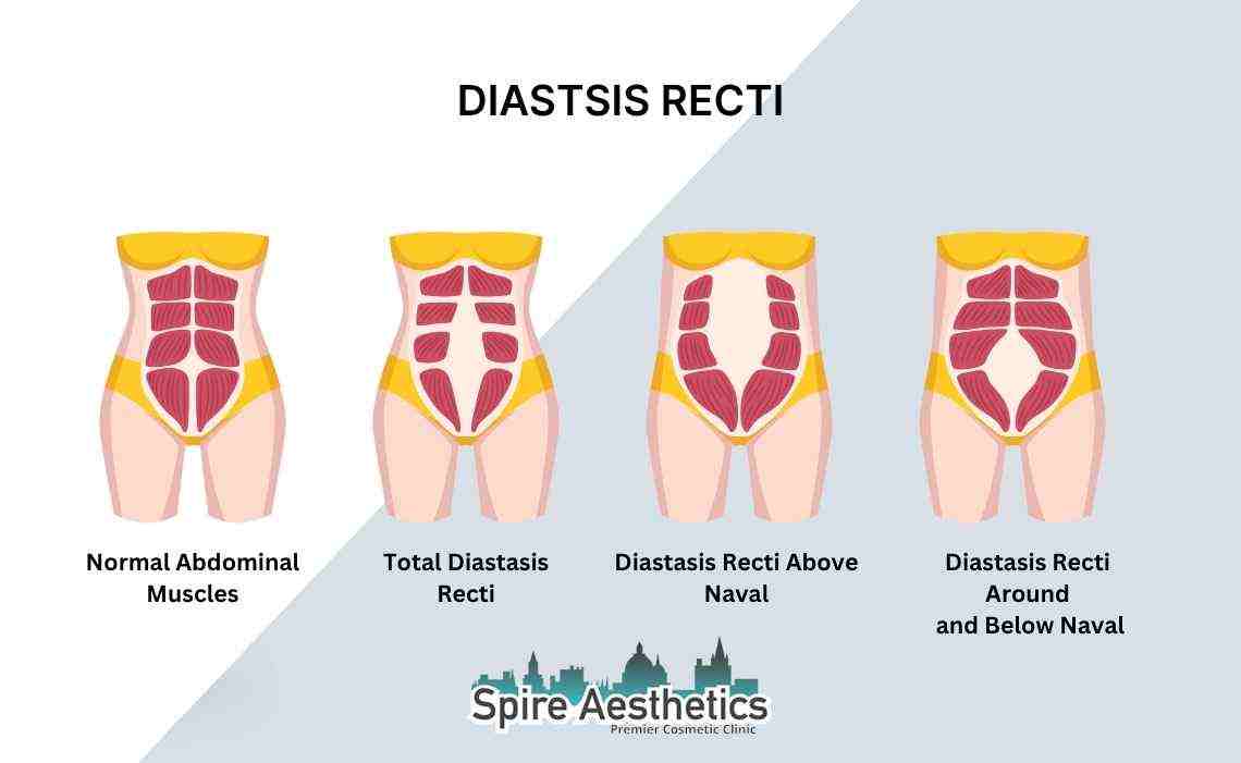 Is Non-Surgical Diastasis Recti Treatment Right for You? Common Concerns Answered Wales